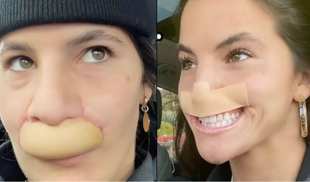 Model whose lip was bitten off by dog shows off transformation after six surgeries