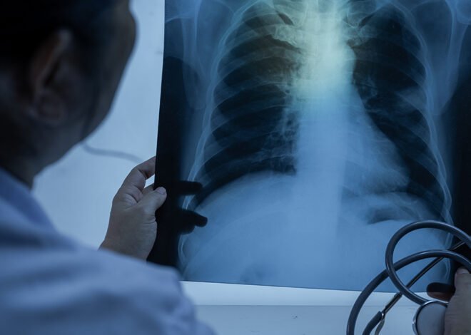 Silent symptom leads to lung cancer death of athletic non-smoker