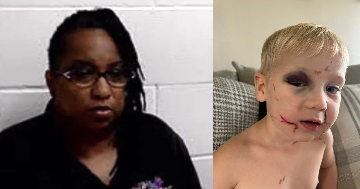 Daycare worker arrested after toddler arrives with black eye and swollen face on first day