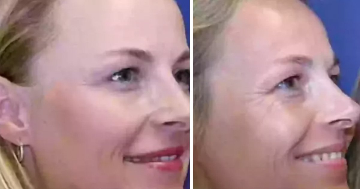 Identical twins share botox results after 20 years – one used it and the other didn’t