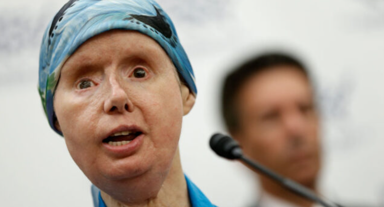 The sad story of Charla Nash, the woman whose face was ripped off by an chimpanzee