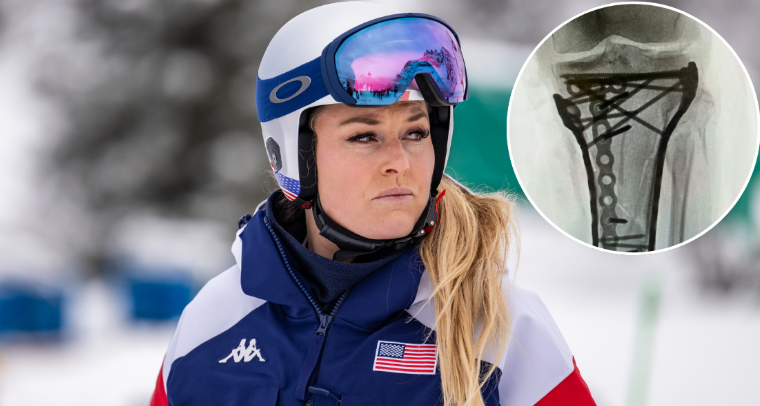 Lindsey Vonn Shares X-Rays Of Her Severe Leg Injury, Provides Update Following Six-Hour Surgery